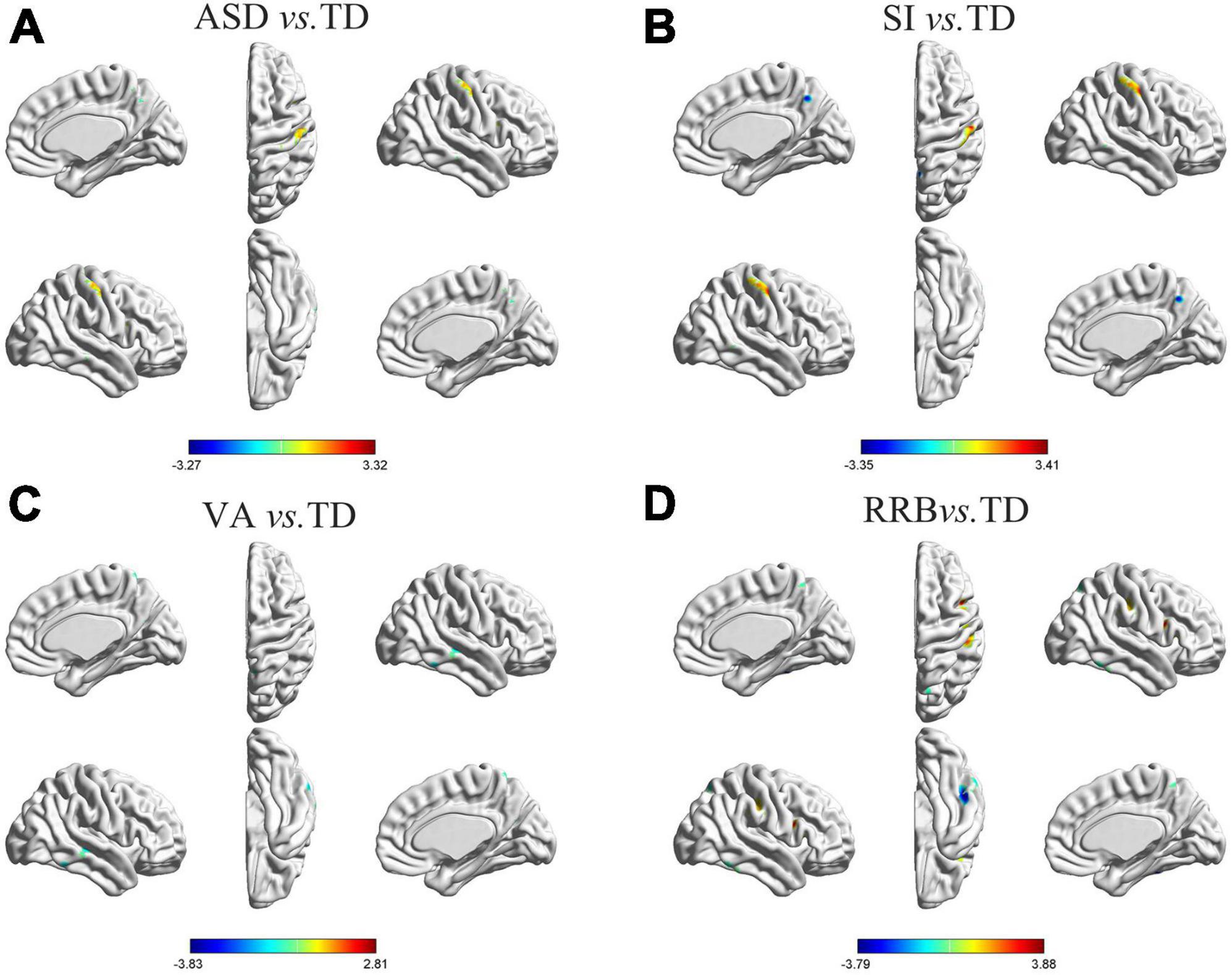 Gray matter asymmetry atypical patterns in subgrouping minors with autism based on core symptoms